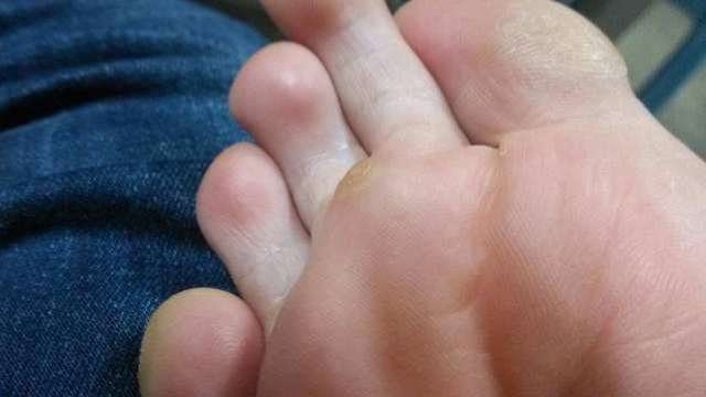鸡眼怎么根治 脚底长鸡眼怎么办第1张-揣书百科